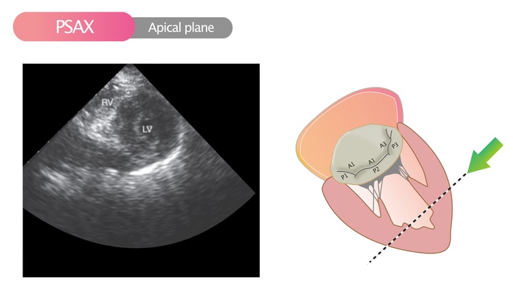 Figur 10. Parasternalt kortaksebilde (PSAX) i apikalplanet.