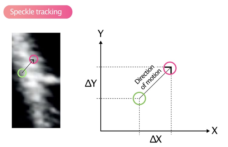 Figur 8. Speckle tracking.