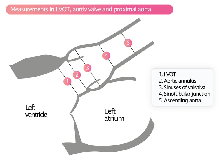 Figur 5. Målinger i LVOT, aortaklaffen og proksimale aorta.