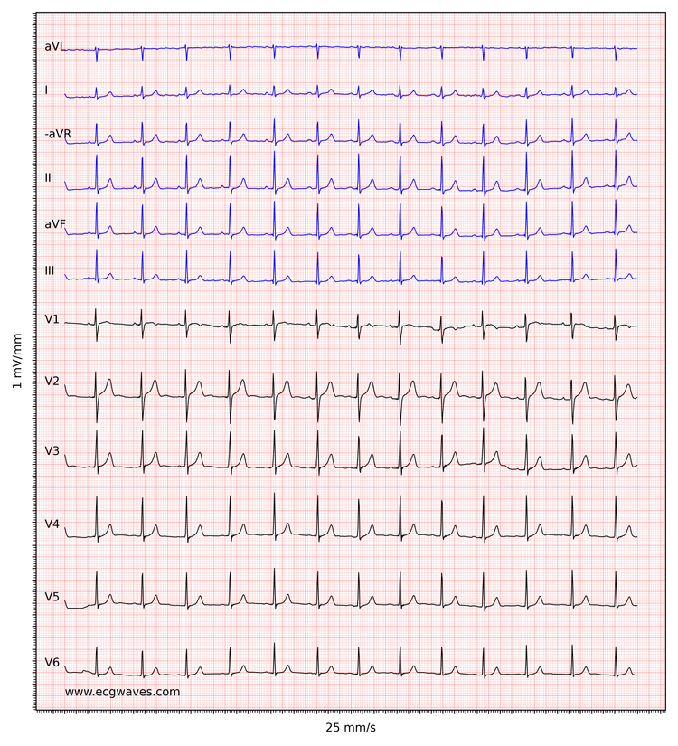 EKG-eksempel 1. Normal sinusrytme.