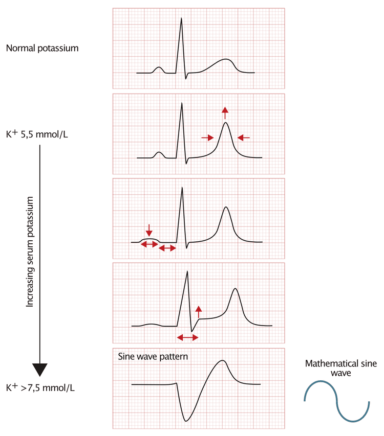 Figur 1. EKG-forandringer ved hyperkalemi.