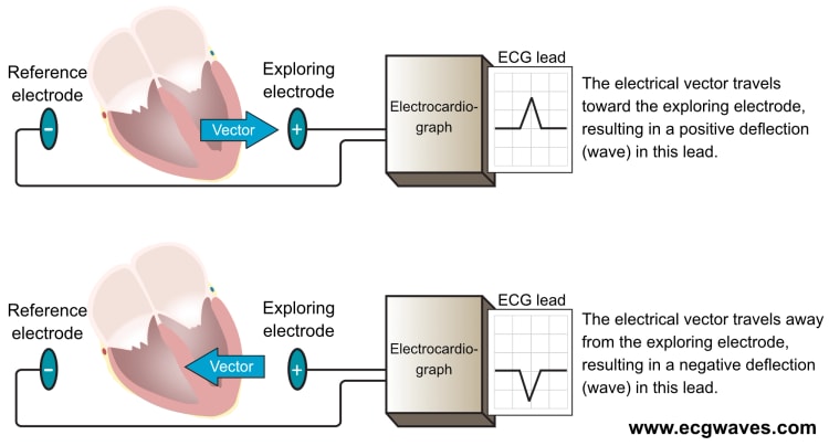 Figur 6. En EKG-avledning viser en EKG-kurve (diagram). Det er nødvendig med minst to elektroder for å få en EKG-avledning. Den ene elektroden fungerer som referanse, og den andre fungerer som utforskningselektrode. Elektrokardiografen sammenligner de elektriske potensialene som registreres i elektrodene. Hvis en vektor beveger seg mot den utforskende elektroden og bort fra referanseelektroden, skrives det ut en positiv bølge.
