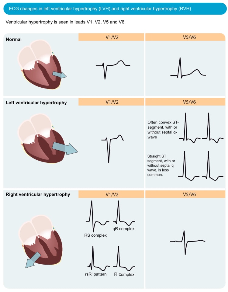 Figur 1. EKG-forandringer ved venstre ventrikkelhypertrofi (LVH) og høyre ventrikkelhypertrofi (RVH). Den elektriske vektoren i venstre ventrikkel er forsterket ved venstre ventrikkelhypertrofi, noe som resulterer i store R-bølger i venstresidige avledninger (V5, V6, aVL og I) og dype S-bølger i høyresidige brystavledninger (V1, V2). Høyre ventrikkelhypertrofi forårsaker store R-bølger i høyresidige brystavledninger og dypere S-bølger i venstresidige avledninger.