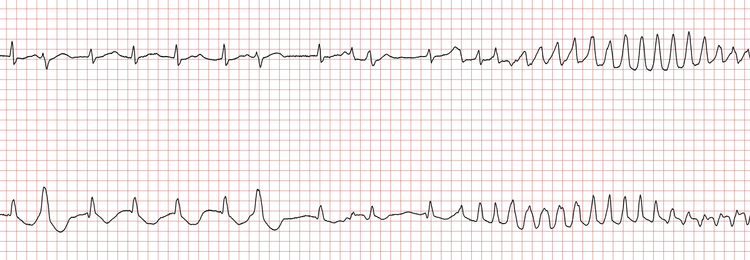 EKG som viser atrieflimmer som går over i polymorf ventrikkeltakykardi