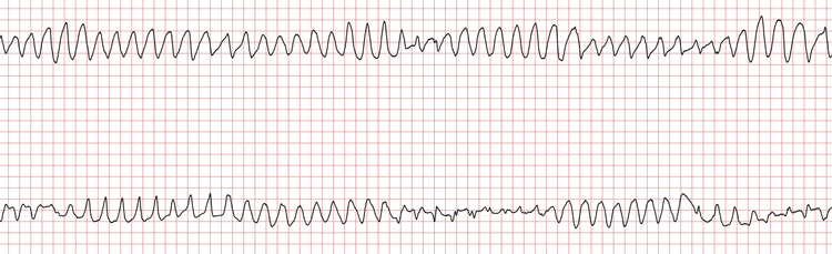 EKG stripe som viser pågående polymorf VT
