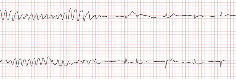 EKG som viser avslutning av VT