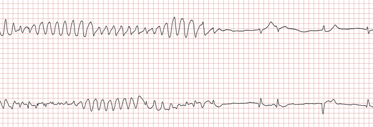 EKG med tilbakefall av VT