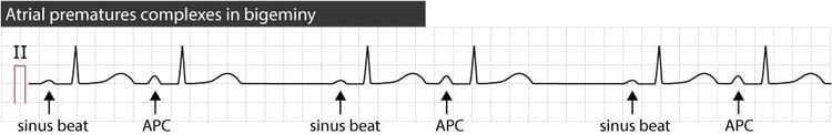 Figure 6. Atrial premature contractions in bigeminy.