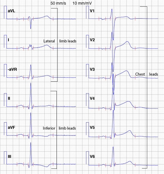 Figure 19. The Cabrera format and inverted aVR.