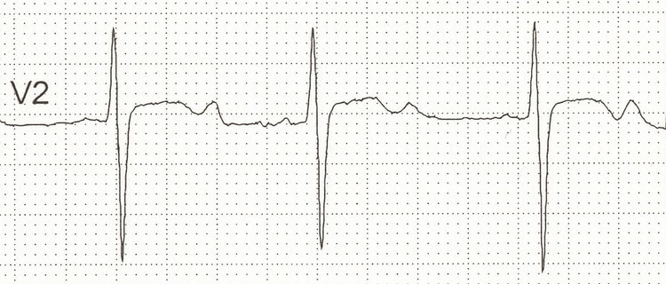 Figure 3. Hypokalemia.