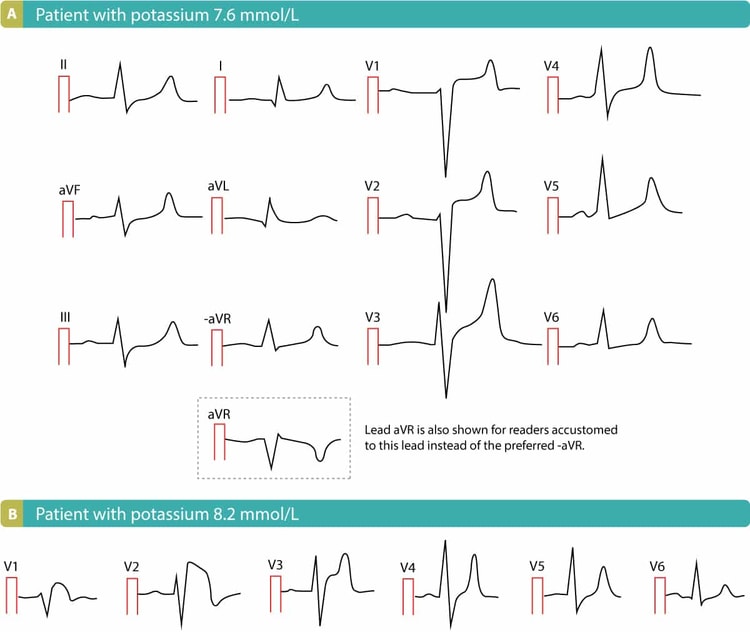 Figure 2. Two cases of hyperkalaemia.