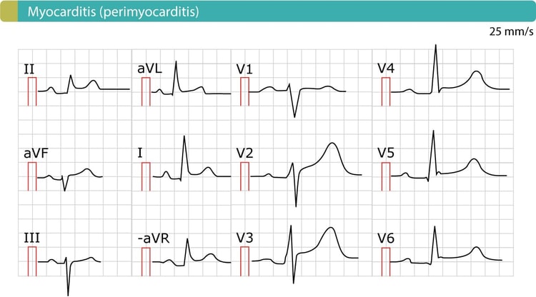Figure 8. Perimyocarditis (myocarditis) causes generalized ST-segment elevations.