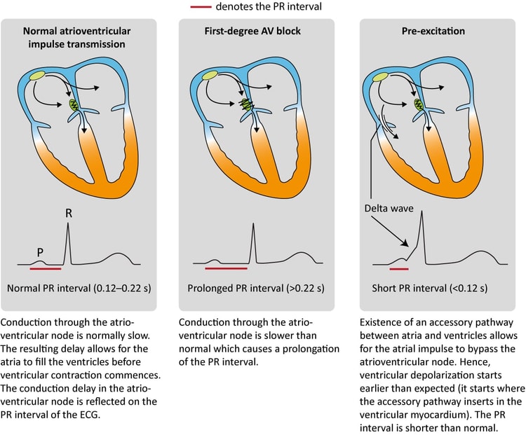 Figure 4. The normal and abnormal PR interval.