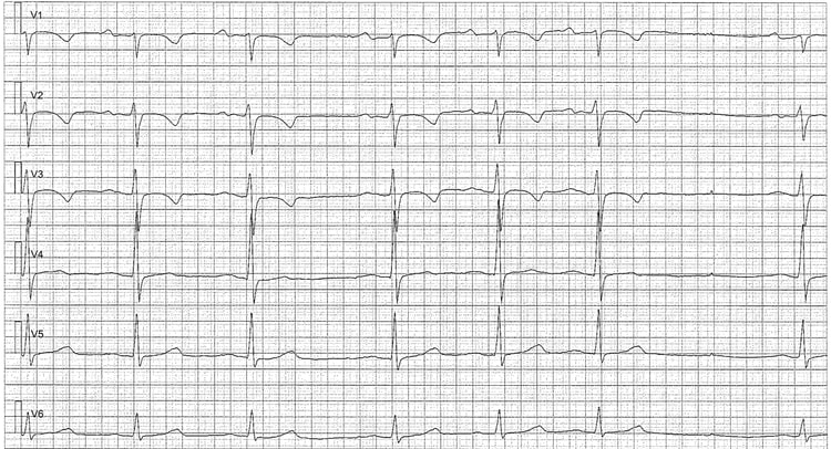 Figur 4. Sinusarytmi med sinuspaus. Negativa T-vågor är normalt i V1–V3 (patienten var 15 år gammal när EKG registrerades).