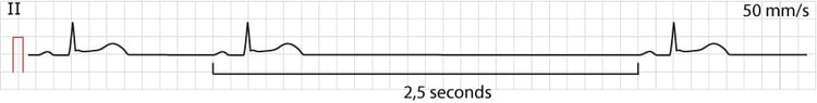 Figure 1. Sinoatrial arrest. Also note the ST-segment elevations (which in this case has no relation to the sinoatrial arrest).