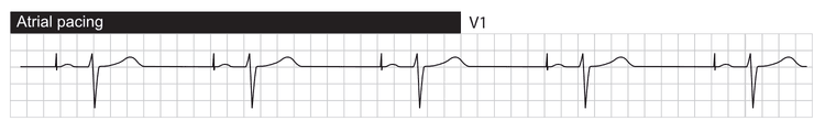 Atrial pacing with normal conduction to the ventricles via the AV system. The ventricles are depolarized via the His-Purkinje network, resulting in normal QRS duration.