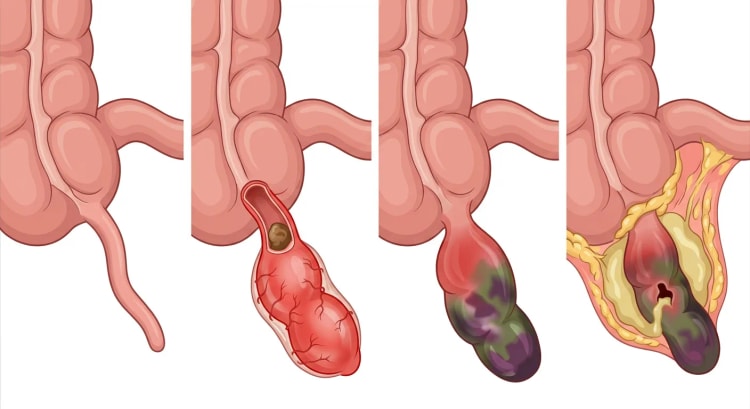 Fire bilder av cøkum med appendiks: normal, inflammert med fekalitt, gangrenøs og perforert med abscess omgitt av oment.