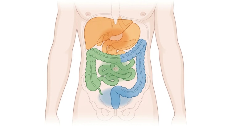 Bukorganer sett forfra, fargekodet etter embryologisk opprinnelse, med tilsvarende smertesoner i epigastriet, periumbilikalt og i hypogastriet.