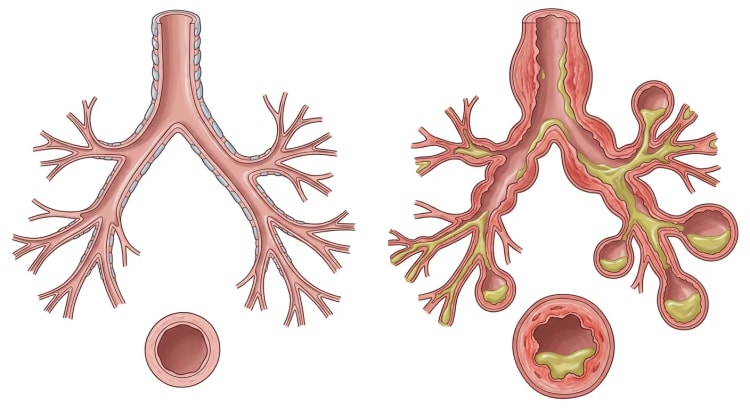 Normalt forgrenet bronkialtre ved siden av et bronkialtre med bronkiektasier, med tverrsnitt av begge.