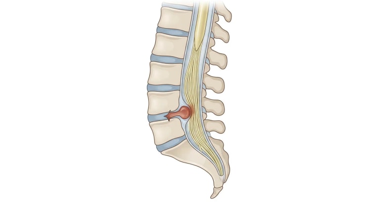 Sagittalt snitt gjennom lenderygg og korsbein der ryggmargen ender i conus medullaris og en bunt nerverøtter fortsetter nedover i durasekken. Et sentralt skiveprolaps mellom fjerde og femte lendevirvel trykker inn i spinalkanalen og klemmer sammen nerverøttene.