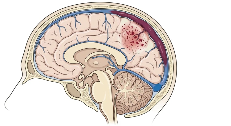 Mediansnitt av hodet med trombose i bakre del av sinus sagittalis superior og et tilgrensende parasagittalt hemoragisk venøst infarkt.