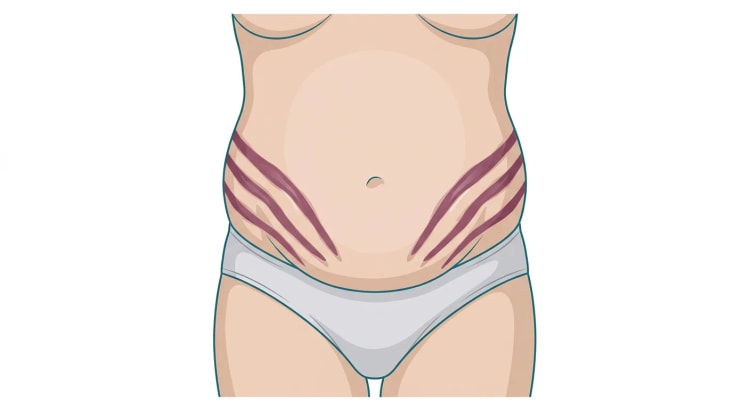 Tegnet nedre del av truncus forfra hos en person med abdominal fedme. På begge flanker og nedre del av abdomen ses flere brede, rødfiolette striae i parallelle bånd som løper skrått nedover.
