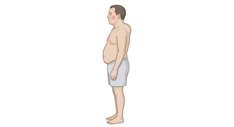 Tegnet mann i profil med rundt, fyldig ansikt og rødme på kinnet, kort og bred hals, tung sentral abdominal fedme samt påfallende tynne armer og bein.
