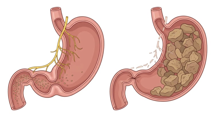 To magesekker side om side: en normal med intakt vagusnerve, antral kontraksjon og åpen pylorus, og en ved gastroparese med skadde nervegreiner, gjenværende fast føde og lukket pylorus.
