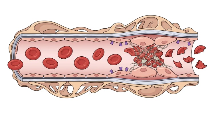 Gjennomskåret glomerulær kapillær der frisk endotelvegg og intakte erytrocytter går over i hovent, skadet endotel med bundet toksin, en trombocytt- og fibrinrik mikrotrombe og fragmenterte erytrocytter nedstrøms.