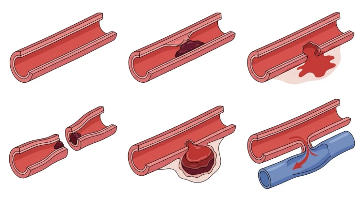 Seks gjennomskårne arteriesegmenter som viser normal arterie og fem typer traumatisk arterieskade.