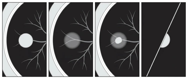 Fire skjematiske CT-utsnitt av lunge i lungevindu: solid nodulus, ren ground glass-nodulus, delvis solid nodulus og perifissural nodulus.