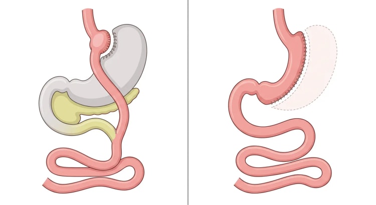 To panelbilder av mage-tarmkanalen: til venstre anatomien etter Roux-en-Y gastrisk bypass, til høyre etter sleeve-gastrektomi.