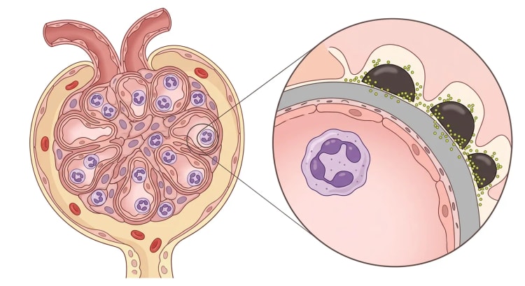 Glomerulus ved poststreptokokk-glomerulonefritt med hypercellulært kapillærnøste og nøytrofile, samt forstørret kapillærvegg med subepiteliale immunkompleksavleiringer.