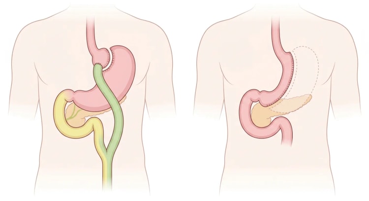 Skjematisk anatomi etter Roux-en-Y gastric bypass til venstre og sleeve-gastrektomi til høyre, sett forfra.