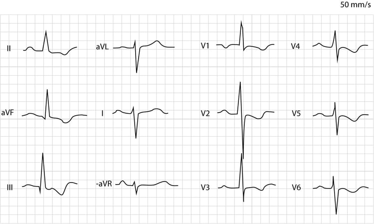 Figure 2. Right ventricular hypertrophy.