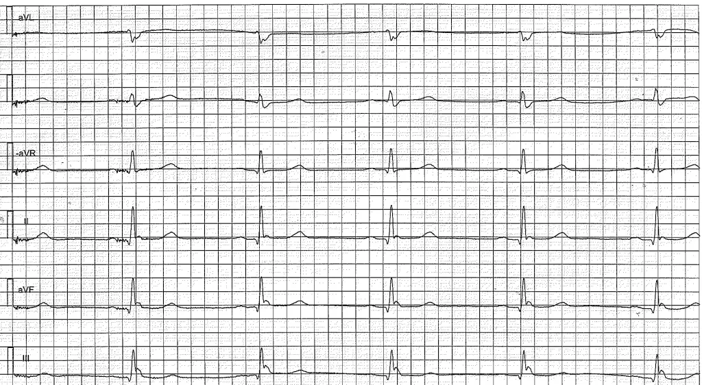 EKG med ekstremitetsavledningene i rekkefølgen aVL, I, −aVR, II, aVF og III. Langsom kammerfrekvens og en positiv defleksjon rett etter QRS-komplekset, tydeligst i II, aVF og III.