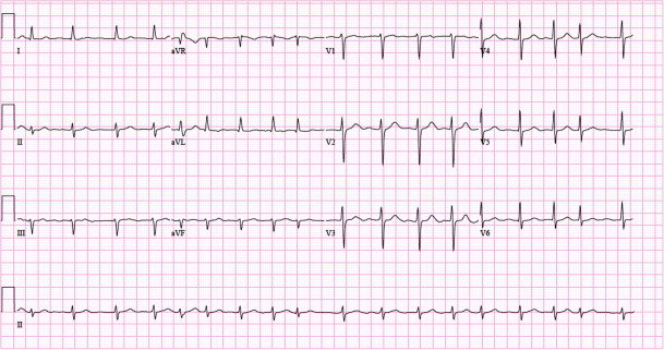 Figur 5. Eksempel på 12-avlednings-EKG med atrieflimmer. Papirhastighet: 25 mm/s.