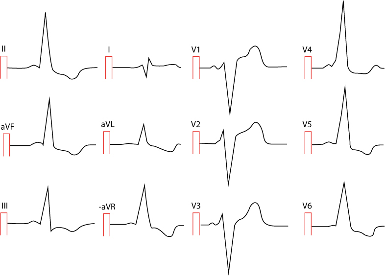 Figur 2. Preeksitasjon hos en 25 år gammel kvinne. Legg merke til uttalt preeksitasjon med ST-segmentdepresjon og T-bølgeinversjon i laterale avledninger. Det er svært kort PR-intervall, brede QRS-komplekser og deltabølger.