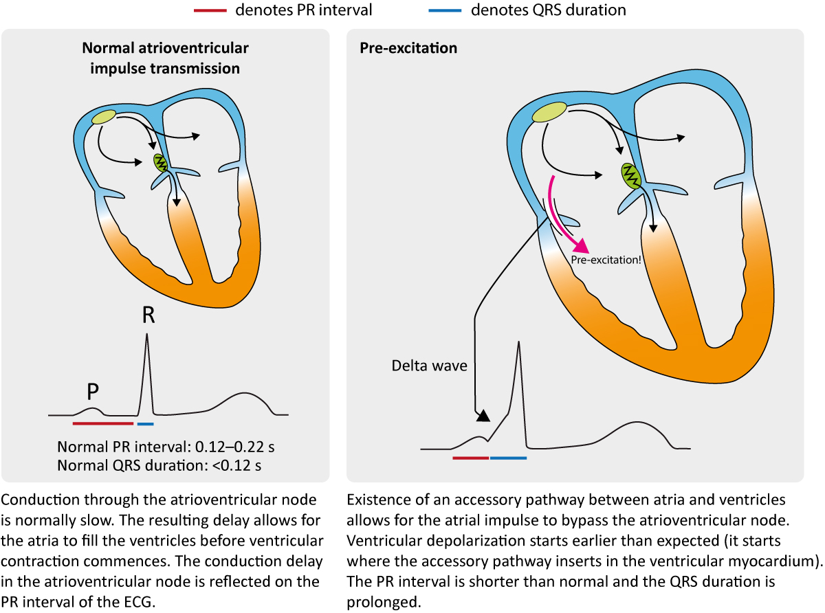 Figur 1. Kjennetegn på preeksitasjon på EKG.