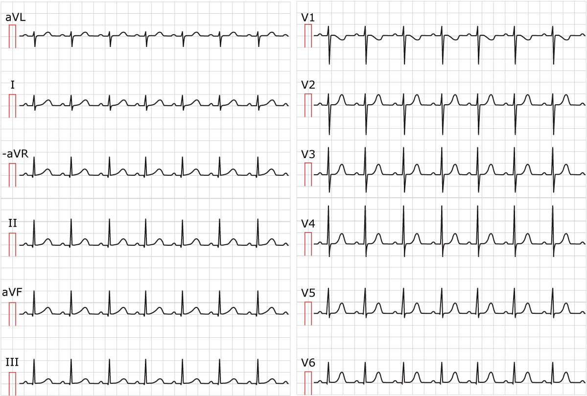 Figur 1. EKG som viser sinustakykardi. Papirhastighet 25 mm/s. Beregn hjertefrekvensen ved å dividere 300 med antallet store ruter mellom R-bølgene. Det er omtrent 3 store ruter mellom R-bølgene; 300/3 tilsvarer 100 slag per minutt.