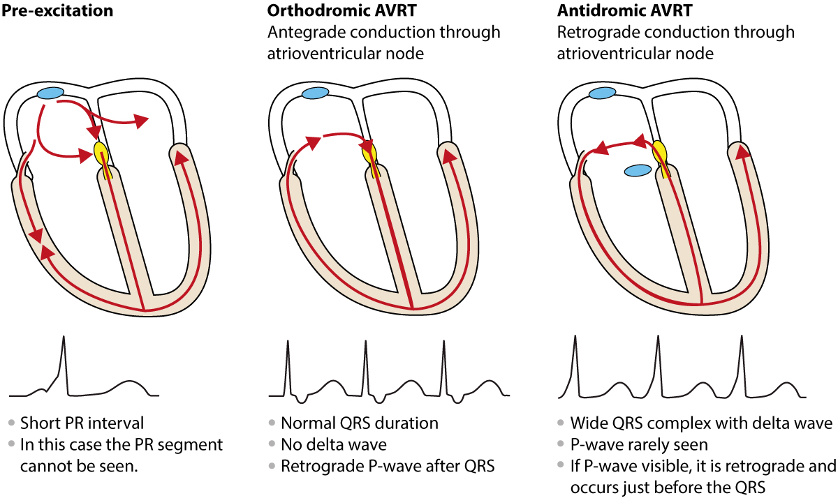 Figur 3. Antidrom og ortodrom AVRT. Ved ortodrom går impulsen ned AV-knuten (normale QRS). Ved antidrom går impulsen ned den aksessoriske banen (brede QRS).