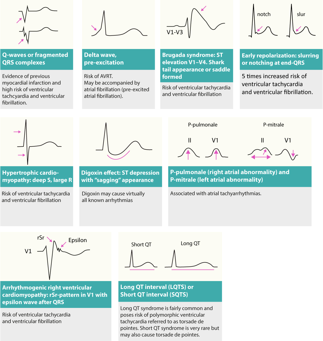 Figur 3. Forandringer på hvile-EKG som kan avsløre årsaken til arytmier (arytmisubstrater).