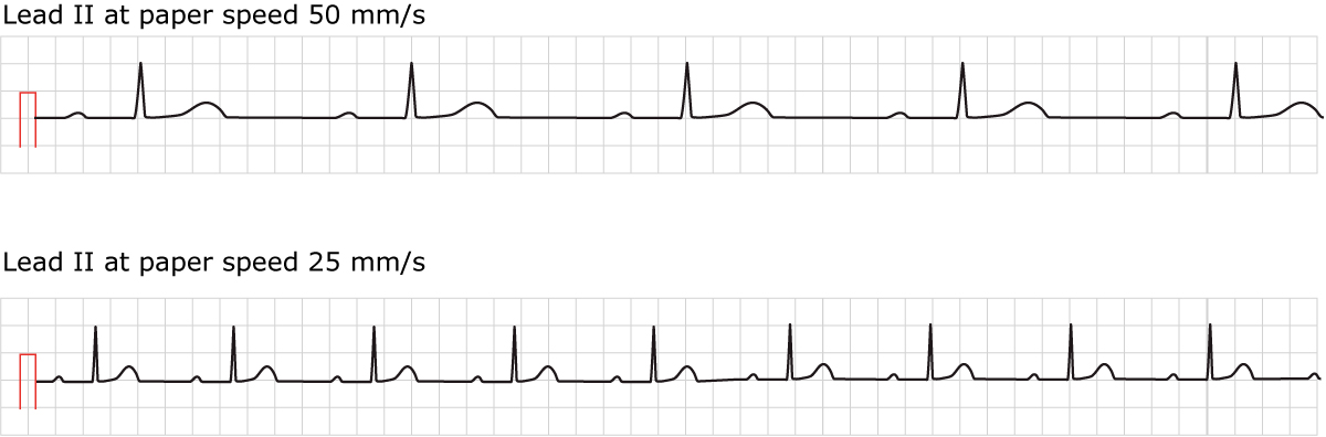 Figur 1. EKG ved førstegrads AV-blokk. Begge vanlige papirhastigheter vises.