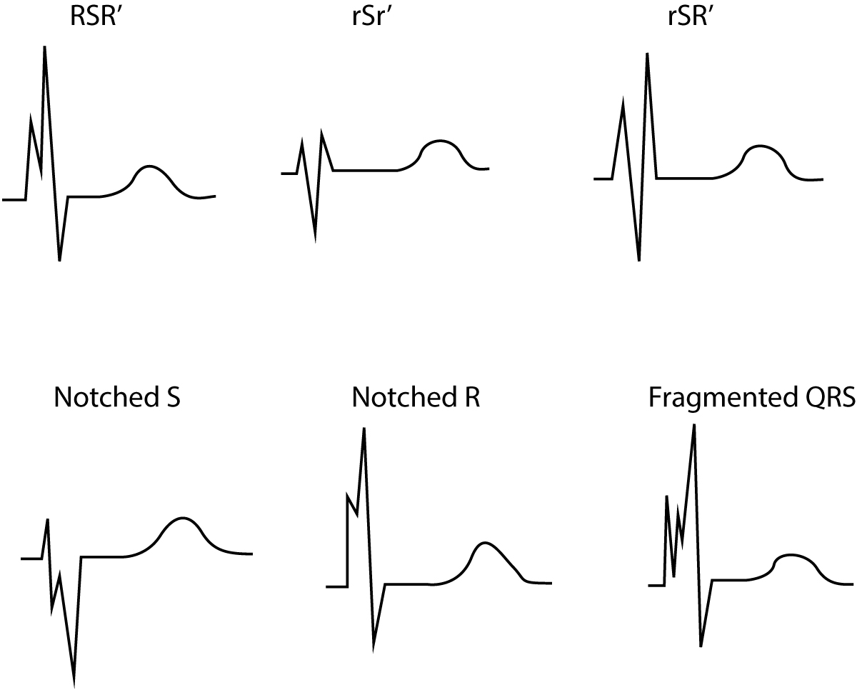 Figur 2. Fragmentert QRS-kompleks. Disse QRS-konfigurasjonene er også tegn på tidligere hjerteinfarkt.