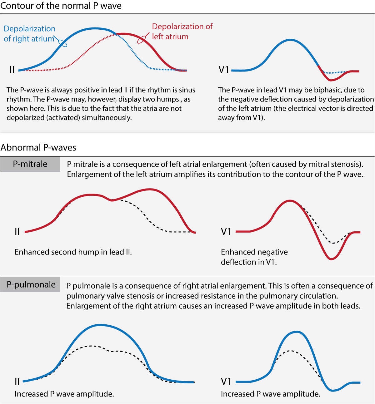Figur 1. EKG-kontur av normal P-bølge, P mitrale (forstørrelse av venstre atrium) og P pulmonale (forstørrelse av høyre atrium). Merk endringene i både amplitude og varighet avhengig av patologi.