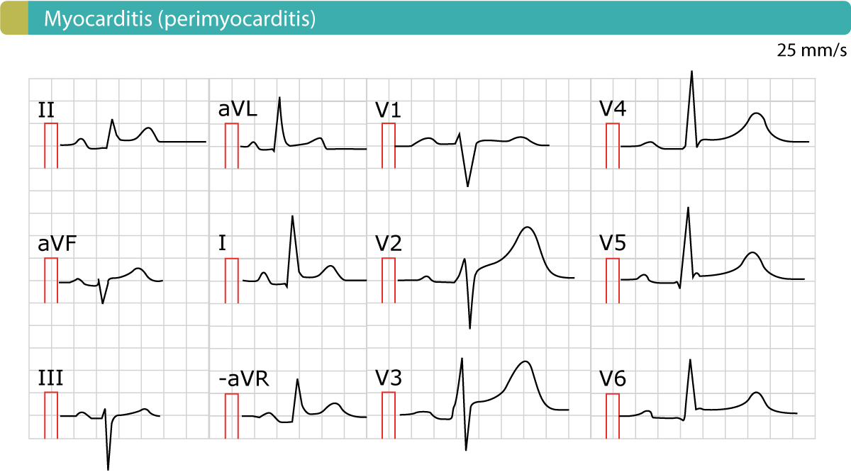 Figur 2. EKG ved akutt perikarditt (myokarditt, perimyokarditt). Som det fremgår, er det generaliserte ST-elevasjoner. Det er ingen gjensidige ST-segmentsenkninger og ingen samtidige T-bølgeinversjoner (negative T-bølger).