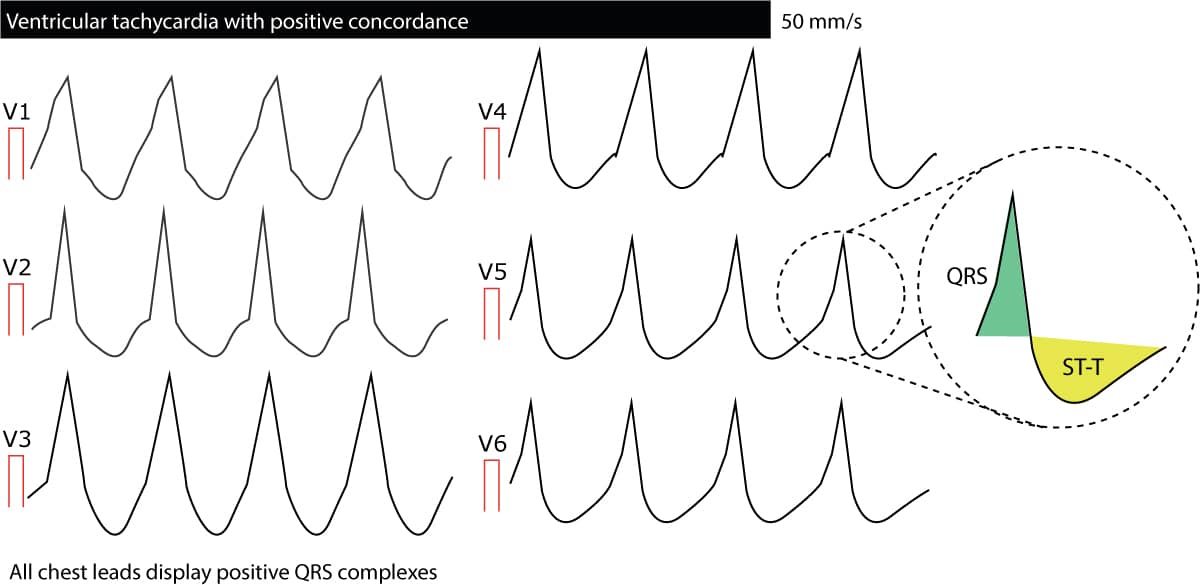 Figur 7. Negativ konkordans i QRS-komplekser fra V1 til V6 ved ventrikkeltakykardi.