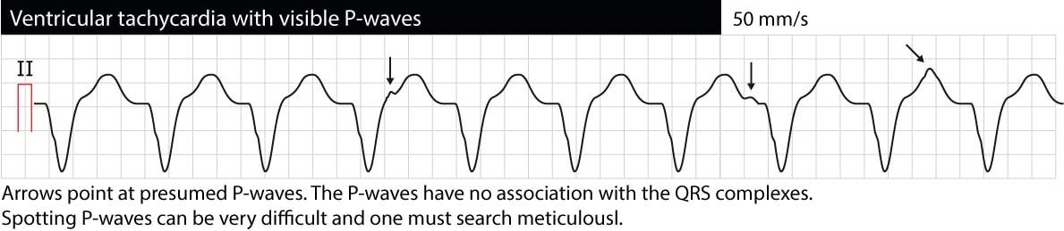 Figur 1 (gjentatt). EKG som viser AV-dissosiasjon med synlige P-bølger uavhengig av QRS.