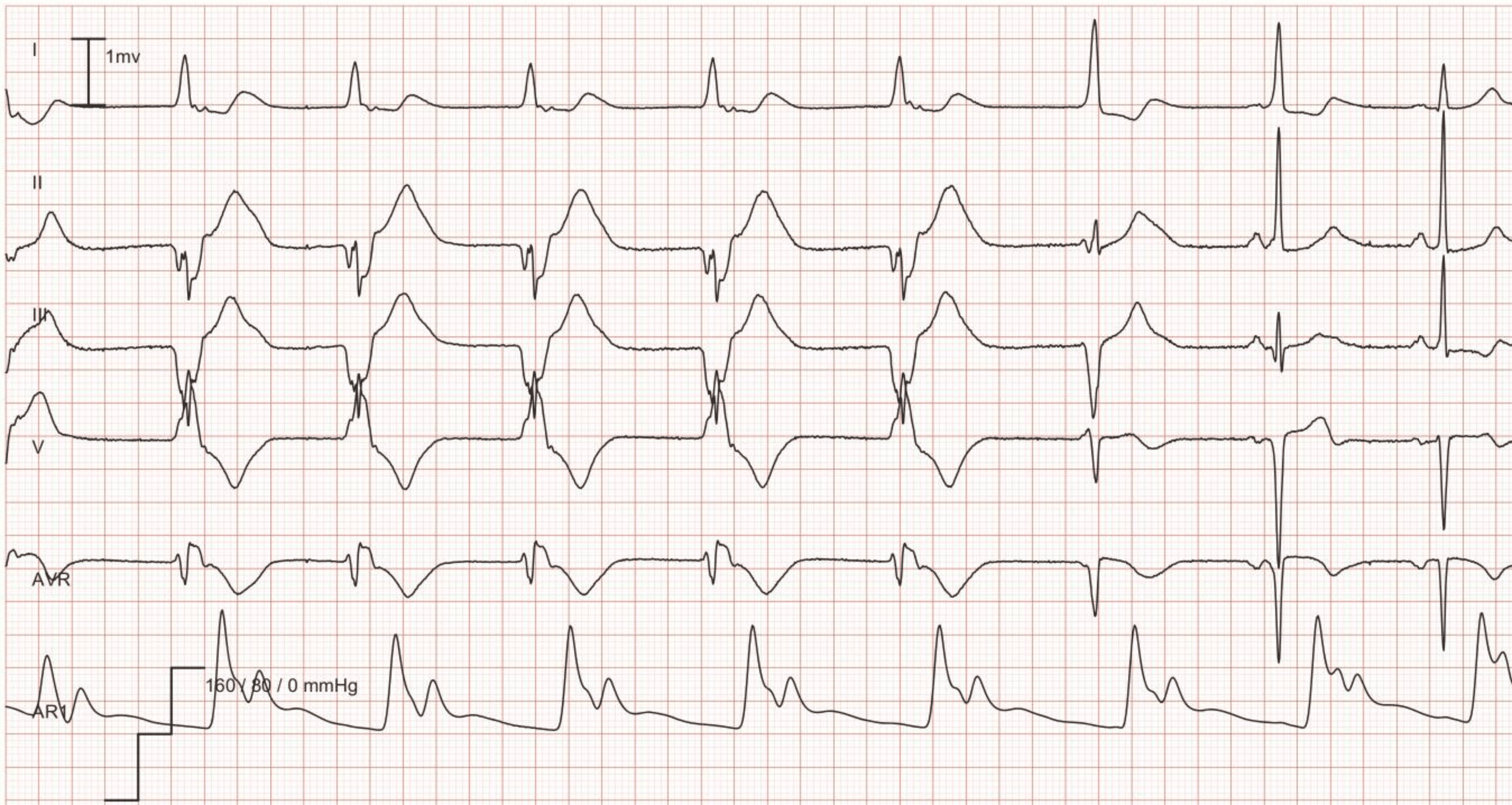 EKG-eksempel: Idioventrikulær rytme (akselerert ventrikulær rytme). Akselerert ventrikulær rytme med en frekvens på 56 i de første 5 slagene, etterfulgt av 2 fusjonsslag; de siste 2 slagene er normal sinusrytme.