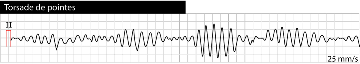 Figur 2. Torsade de pointes (polymorf ventrikkeltakykardi) forårsaket av langt QT-syndrom. Legg merke til den typiske vridningen av QRS-amplitude.